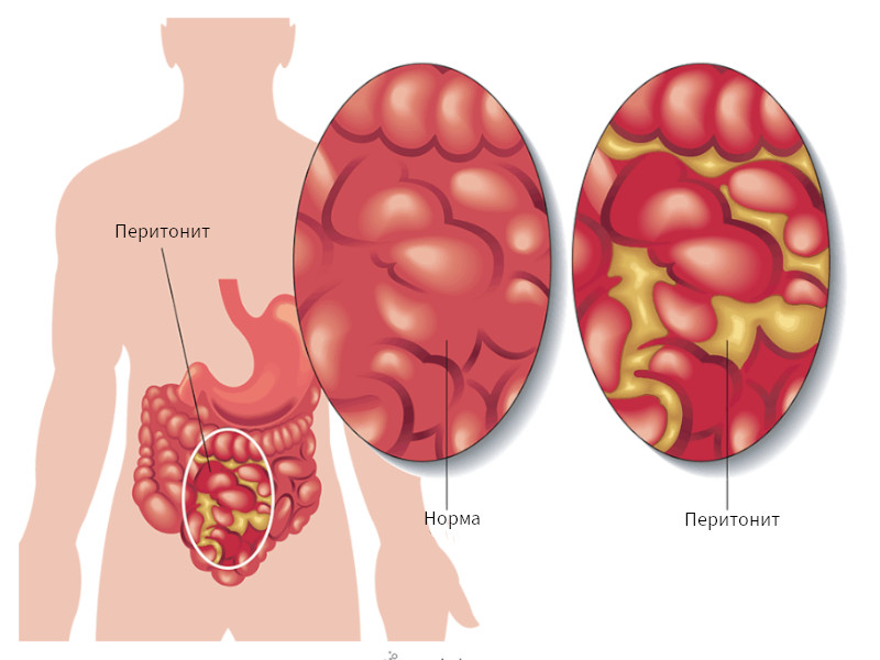Когда вызывать скорую: перитонит — причины, симптомы и лечение