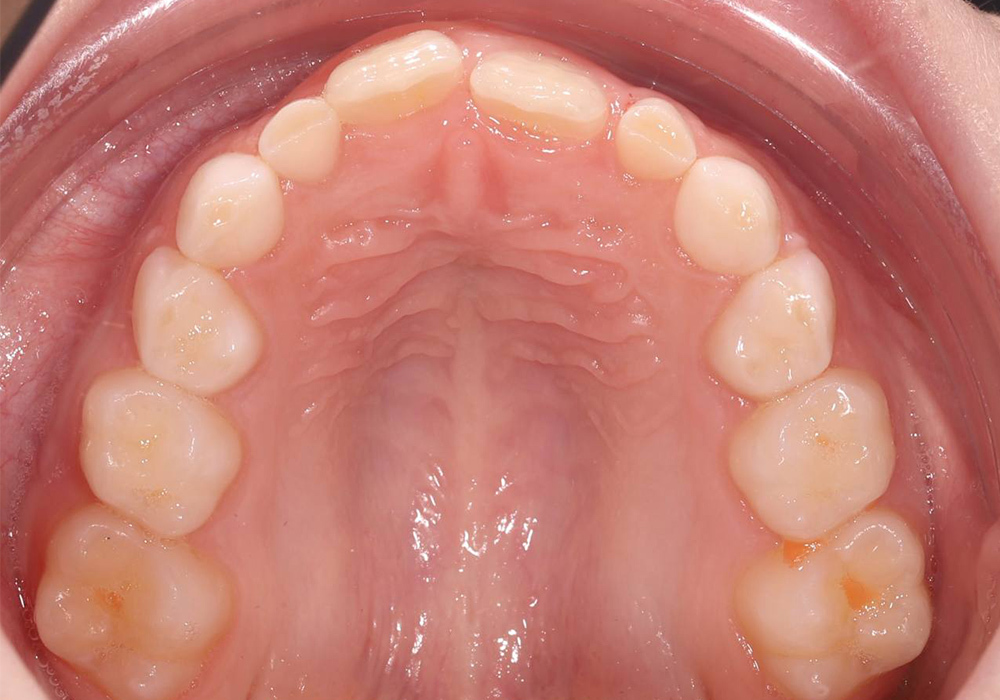 Исправление перекрестной окклюзии у ребёнка в сменном прикусе без хирургии