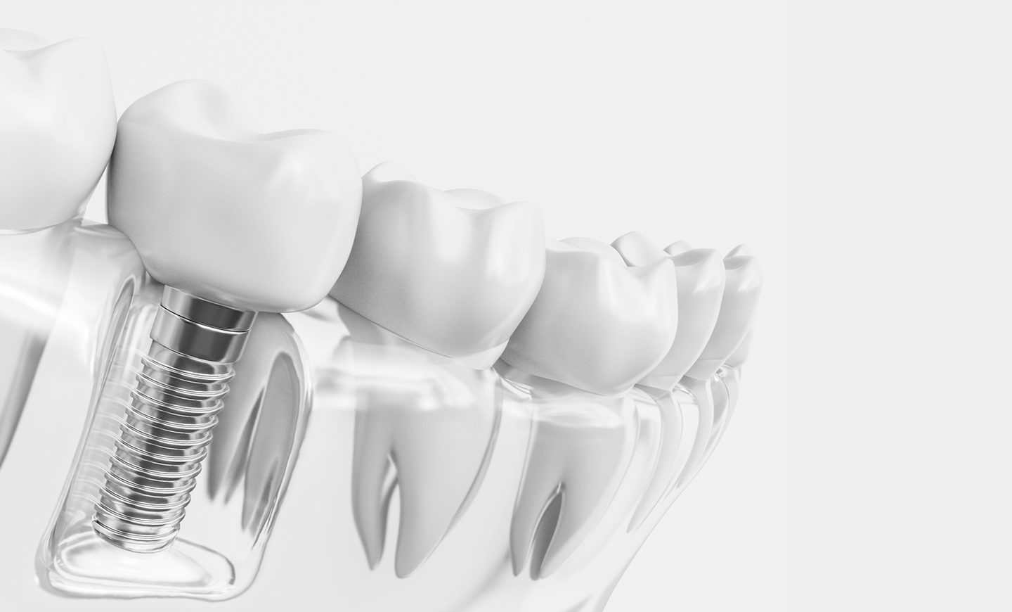 Cuanto cuesta una protesis dental de dos dientes