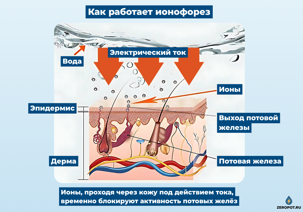 Принцип работы ионофореза - электрический ток блокирует потовые железы через кожу рук