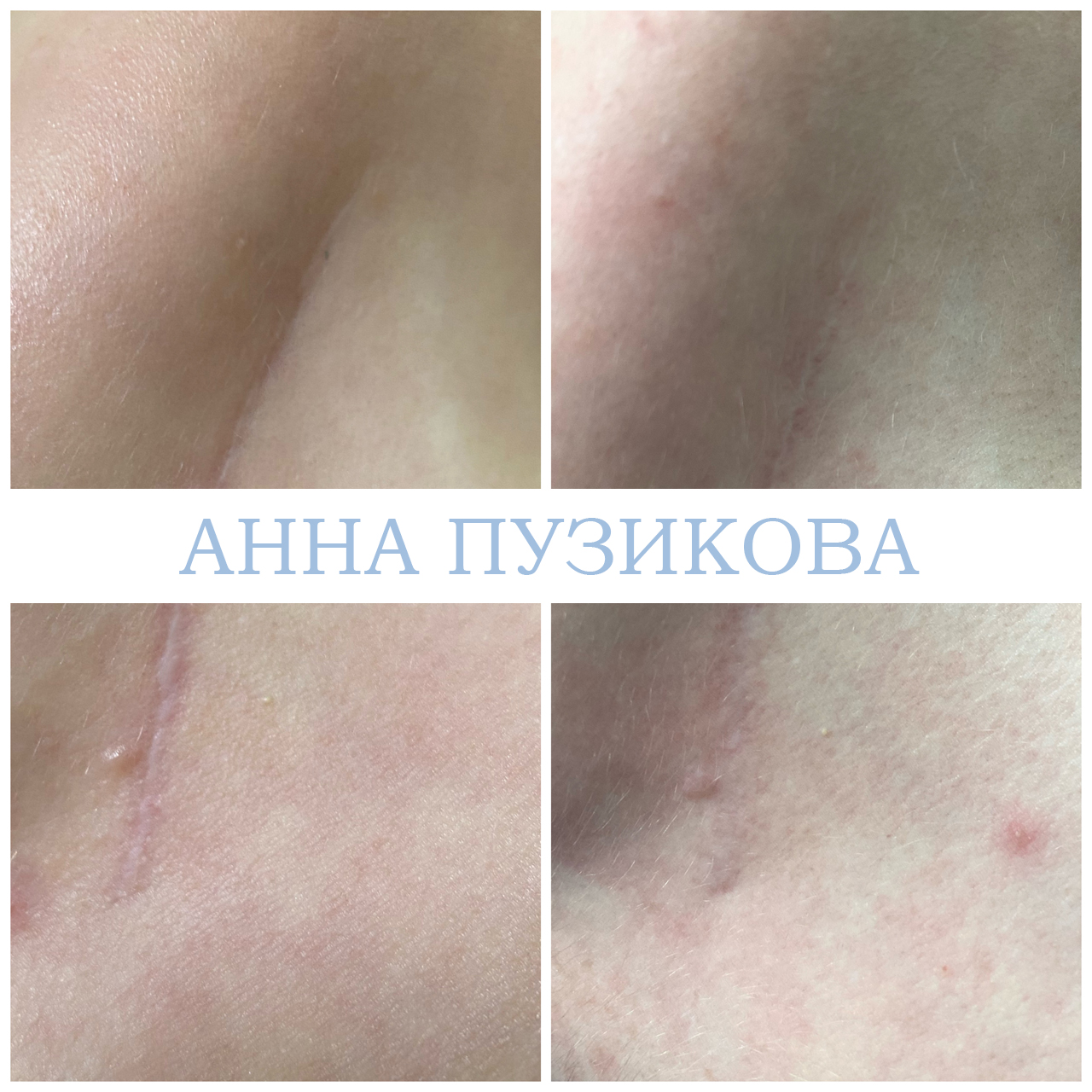 Результат удаления шрама у пациента — косметолог Пузикова Анна Анатольевна, Санкт-Петербург