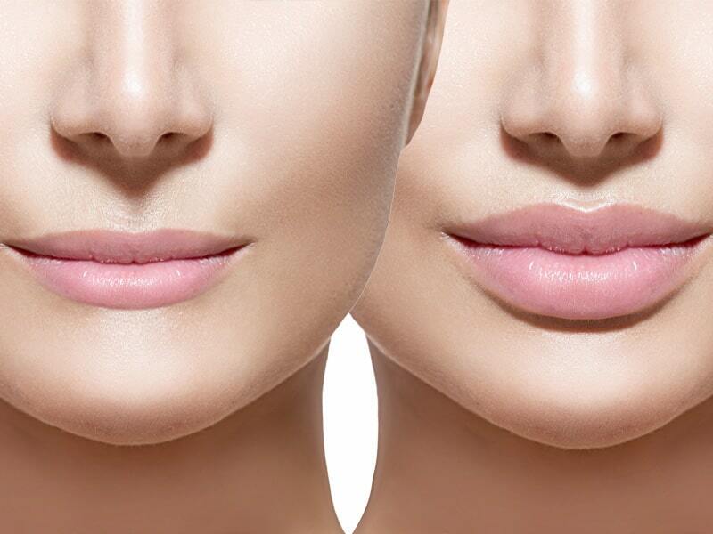 1 мл в губах до и после: фото до и после процедуры