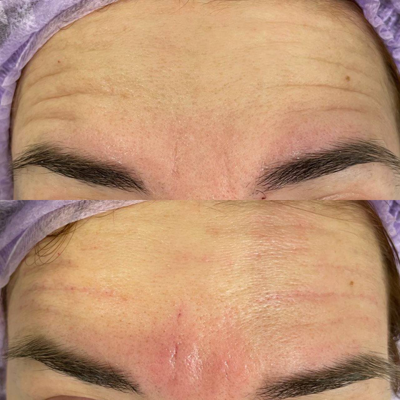 Бланширование морщин белотеро софт. Бланширование морщин что это. Бланшинг в косметологии отзывы. Бланширование морщин белотеро софт. Бланширование морщин белотеро.