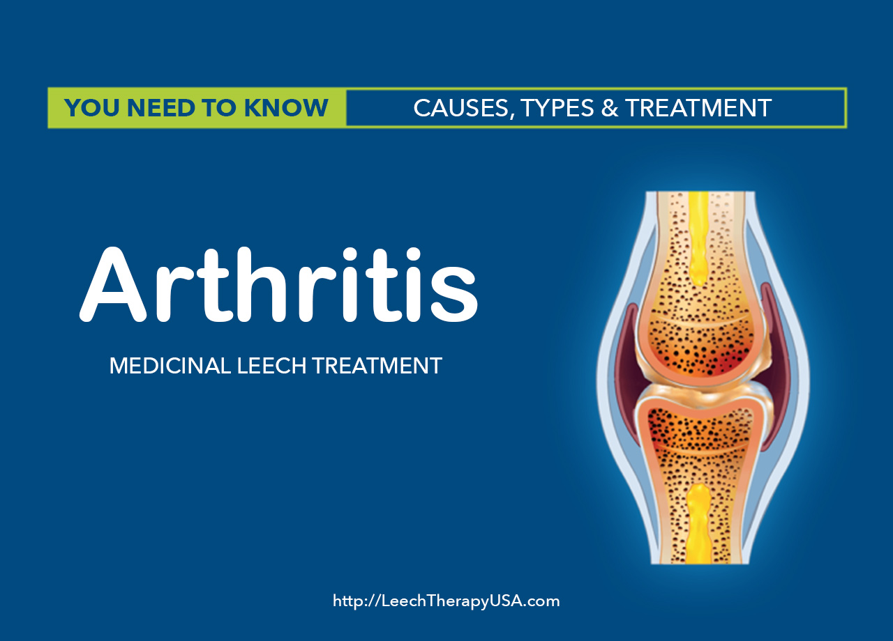 Arthritis treatment in Philadelphia, PA