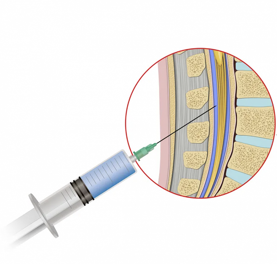 Люмбальная пункция мозга. Люмбальная спинномозговая пункция. Игла для люмбальной пункции. Люмбальная эпидуральная анестезия.