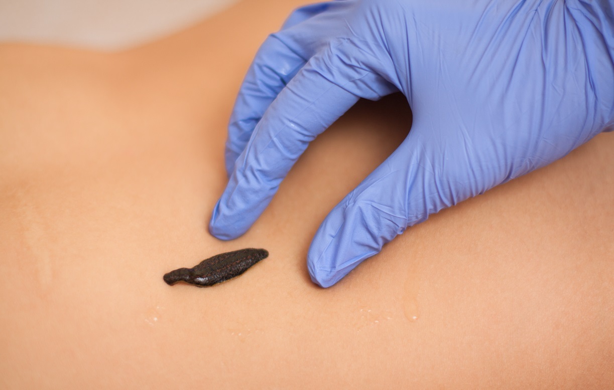 Роль гирудотерапии в улучшении кровообращения и укреплении иммунитета