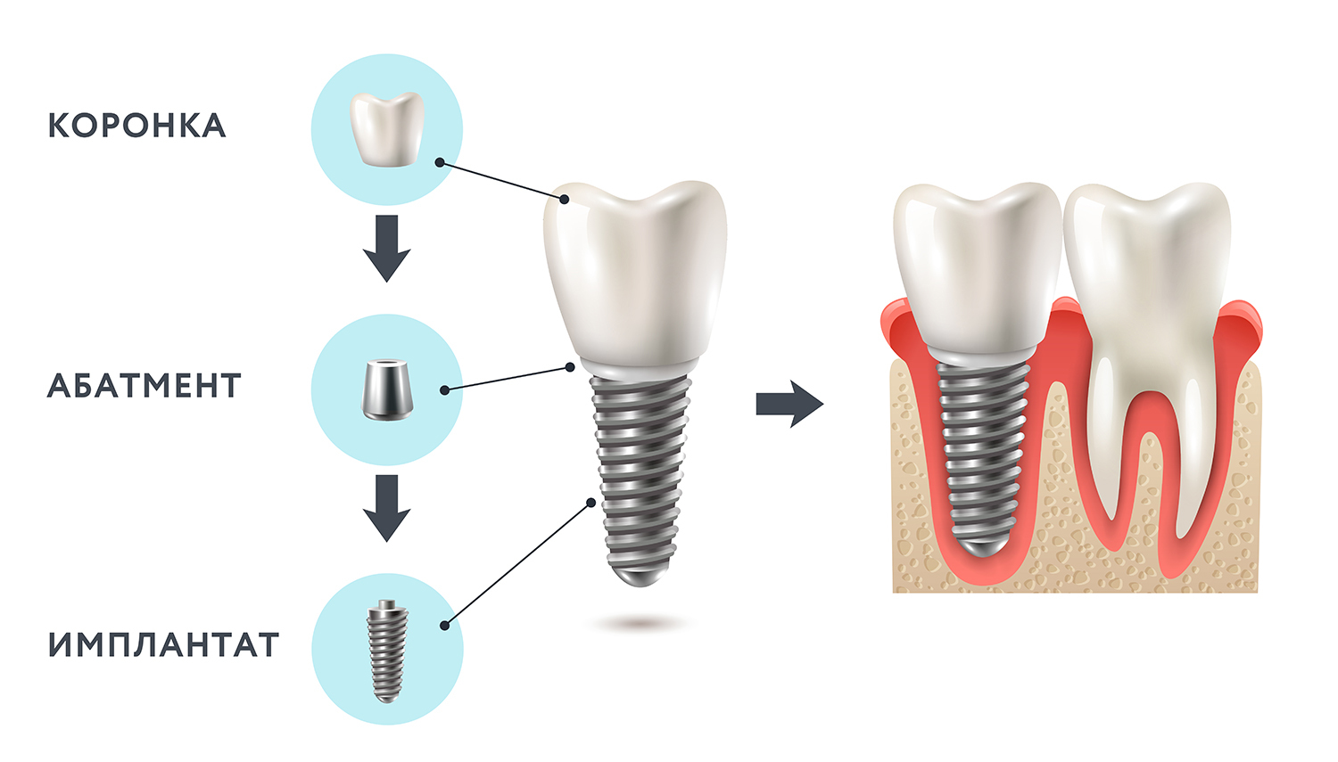 Как делается имплантация зубов на схеме покажите