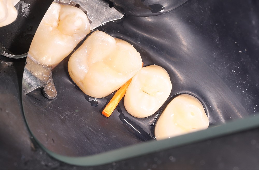 Лечение скрытого кариеса на контактной поверхности с установкой композитной пломбы