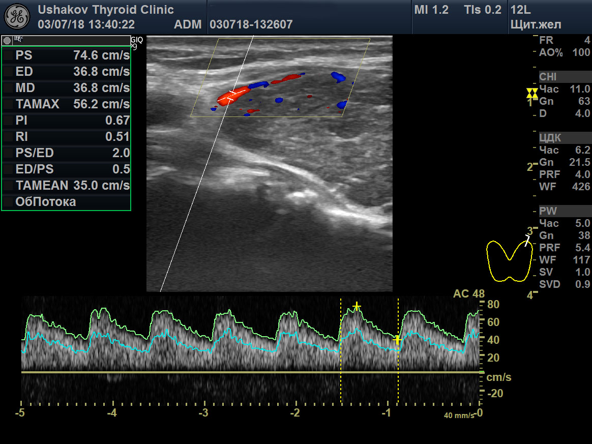 Эхокардиография с допплеровским анализом. УЗИ протокол щит жел.