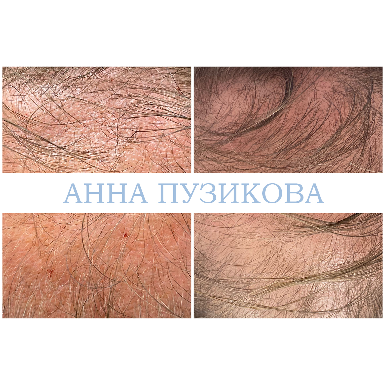 Результат лечения выпадения волос: повышение густоты, укрепление корней и улучшение состояния кожи головы — Прадус СПб.