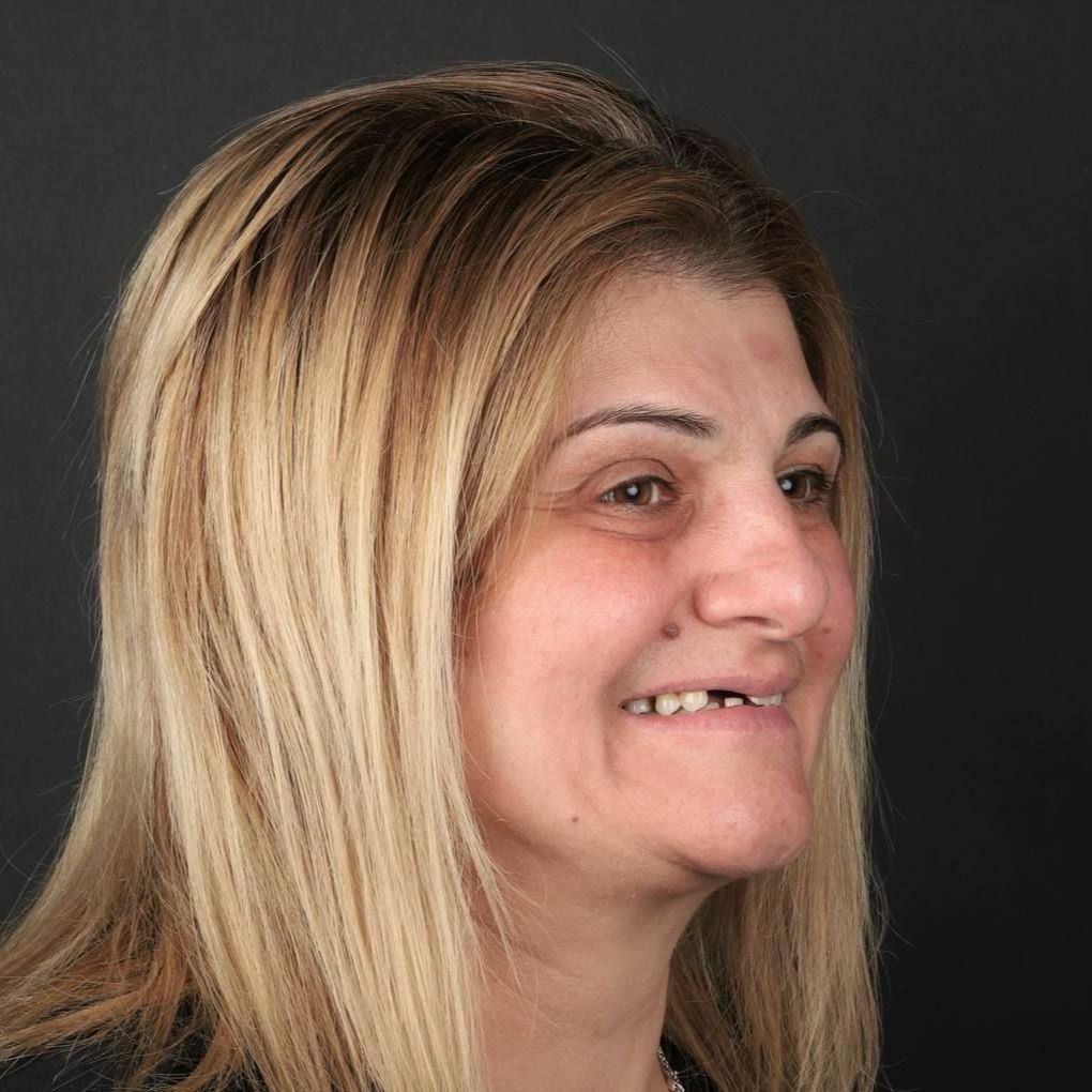 All-on-4, All-in-4 имплантация, протезирование, вернуть зубы, протезирование на имплантах, всё-на-4, все-на-четырех, протезирование зубов