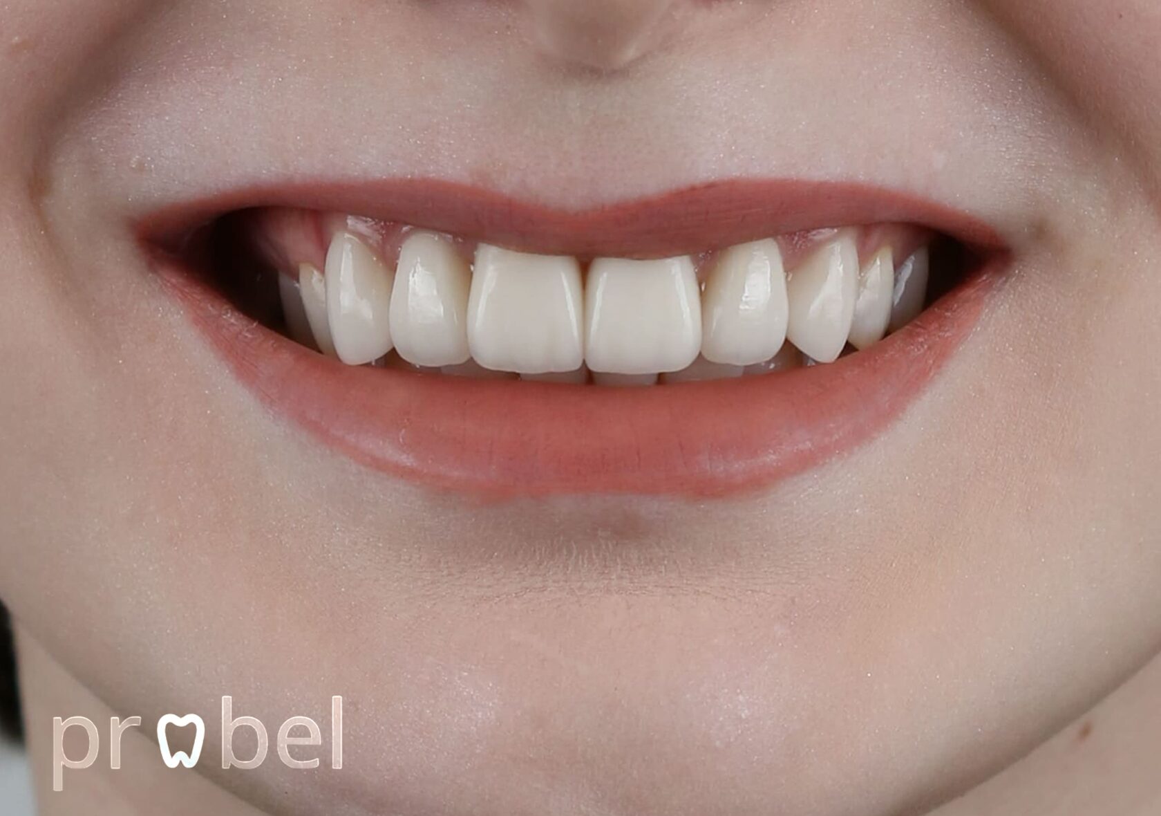 естественная улыбка с восстановленной высотой и формой зубов