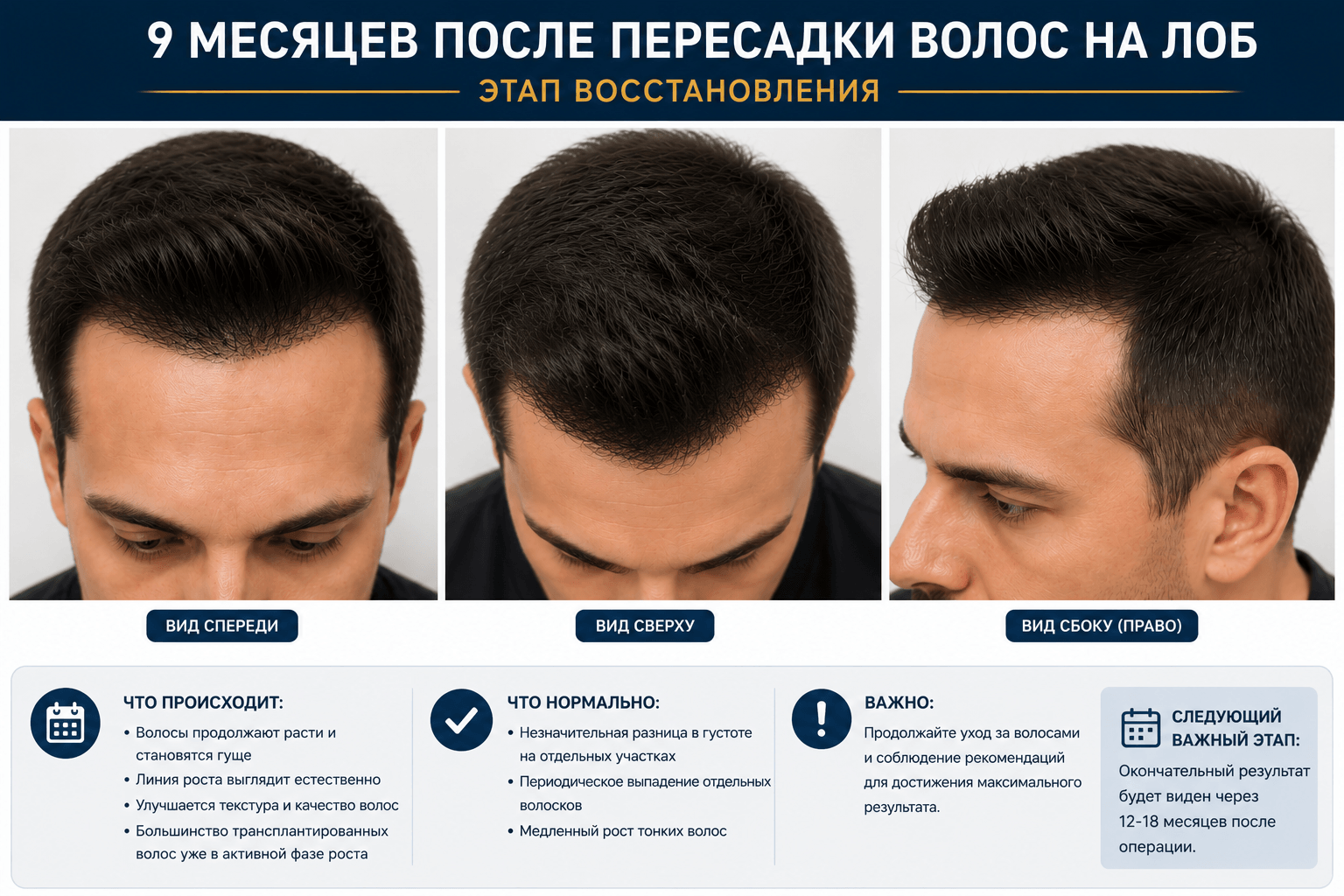 восстановление после пересадки волос на лоб 9 месяцев
