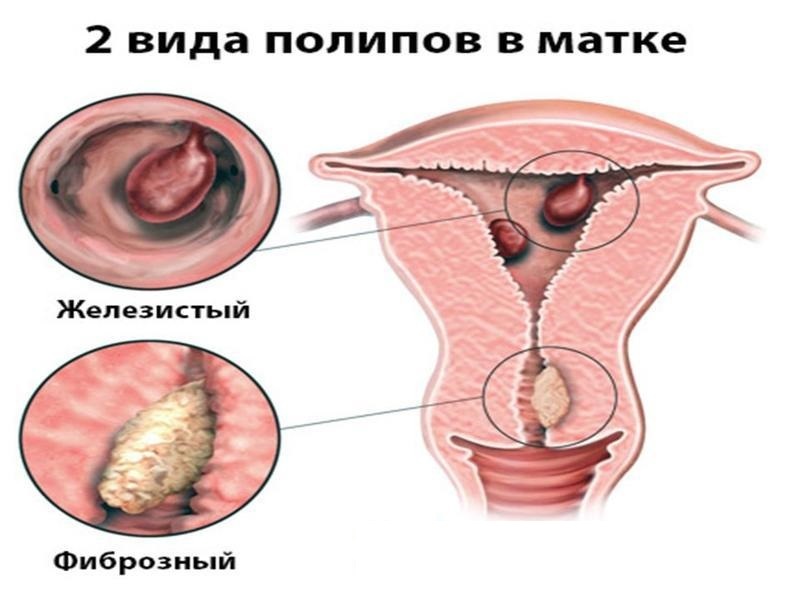 Полипы матки: симптомы, лечение (удаление)