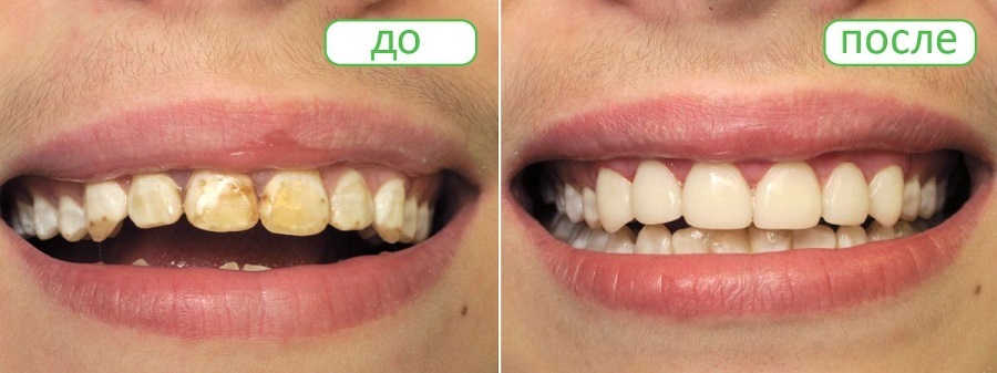 Как отбелить зубы в домашних условиях: 10 секретов сияющей улыбки