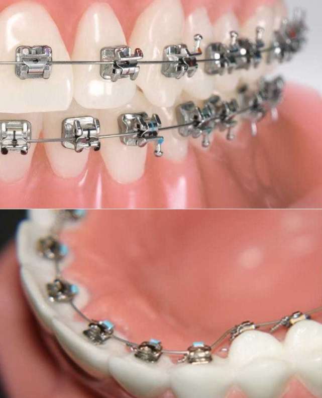 На какие типы делятся брекеты и для чего они нужны