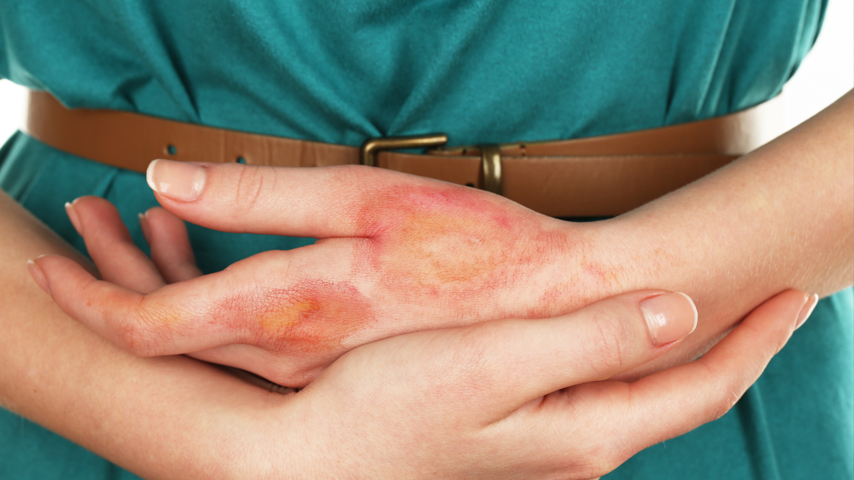 Первая помощь при тепловых ожогах: что можно и нельзя делать