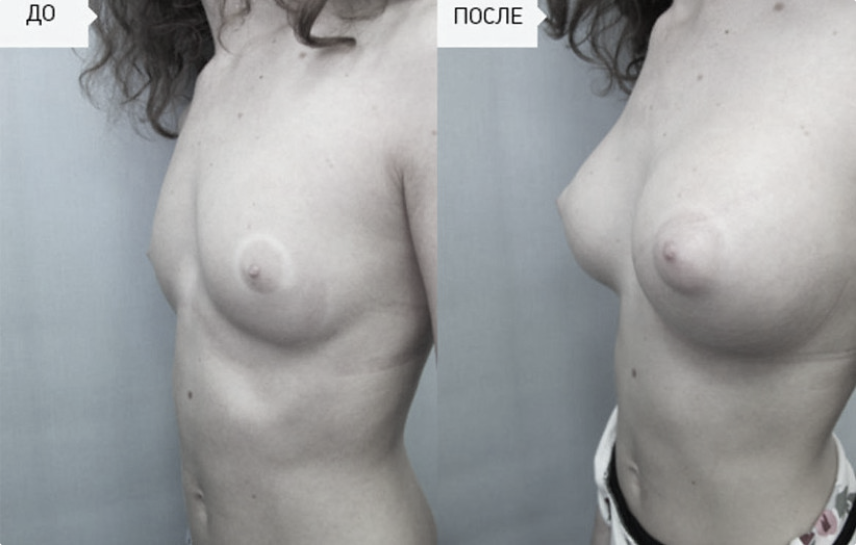 силиконовая грудь до родов фото 76