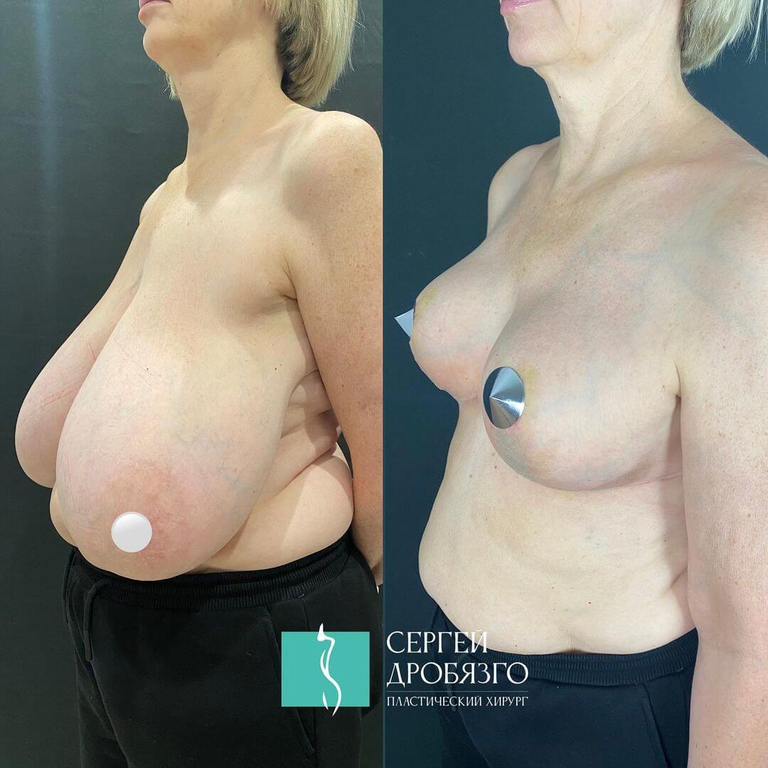 как проходит операция по уменьшению груди у женщин фото 12