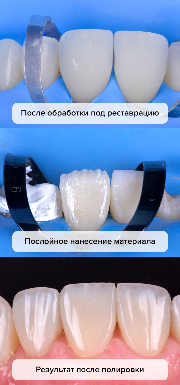 Преимущества профессиональной реконструкции зубов