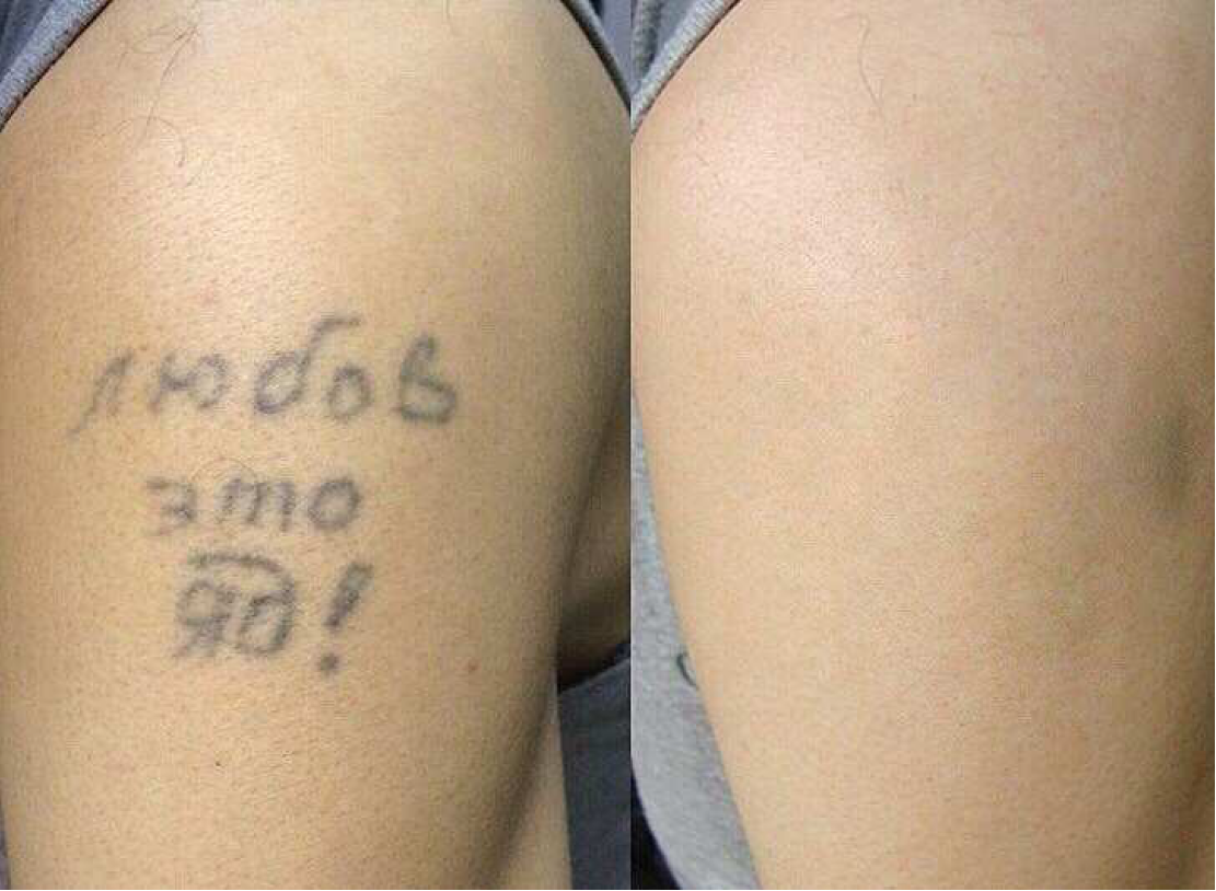 Сведение татуировок лазером. Результат сведения Татуировки. Свод тату