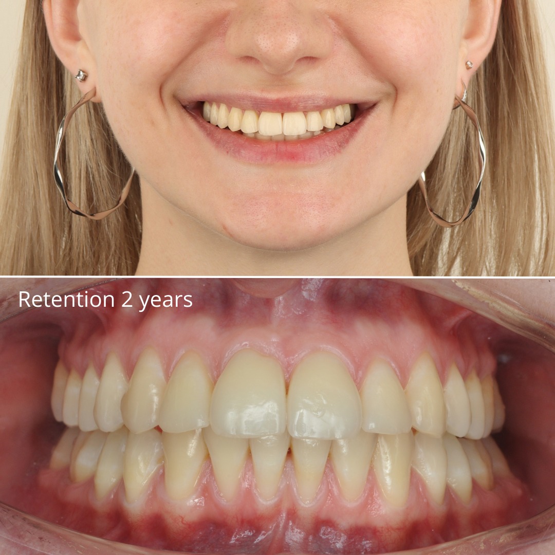 After treatment and two years later: stable, harmonious, non-extraction result — photo 3 of 3