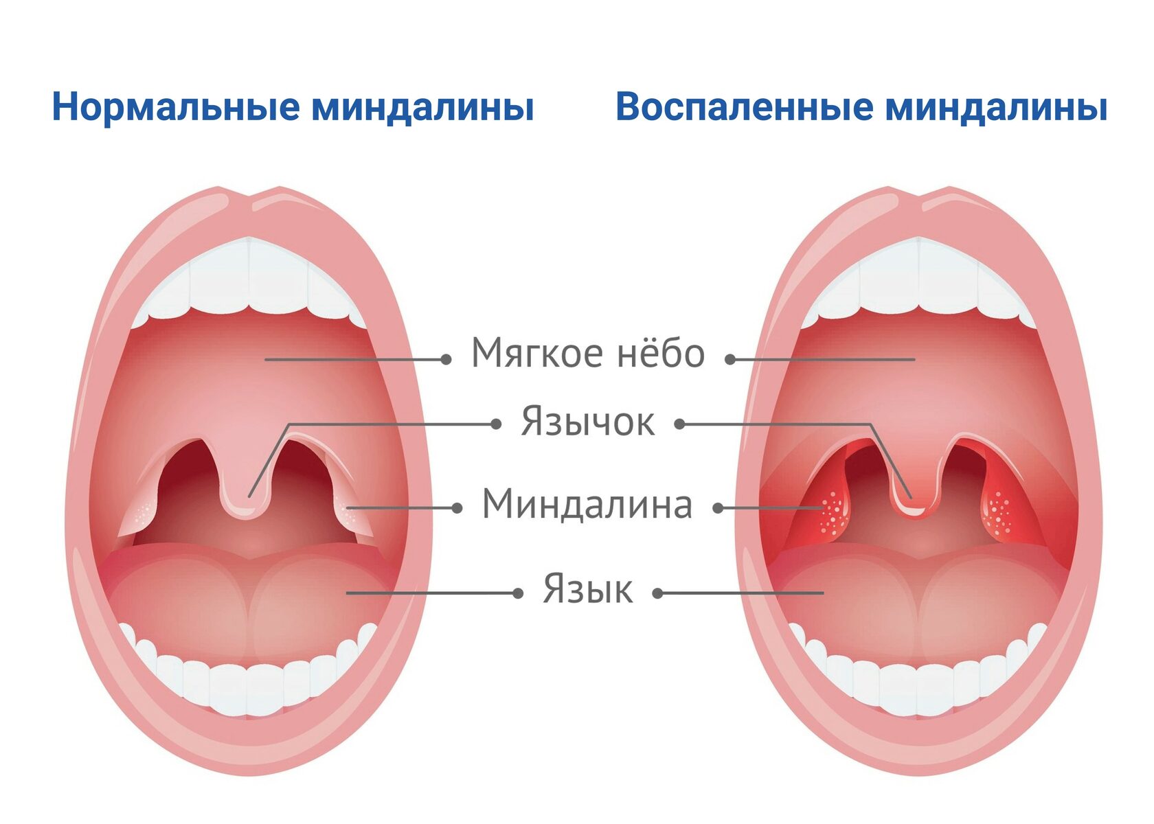 Воспаленное горло фото