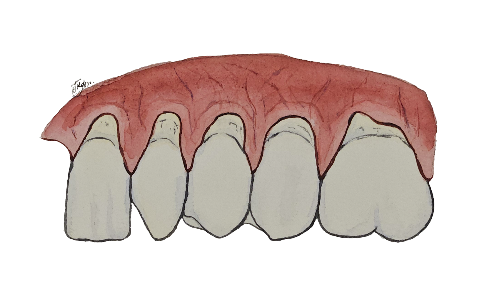 Рецессия десны