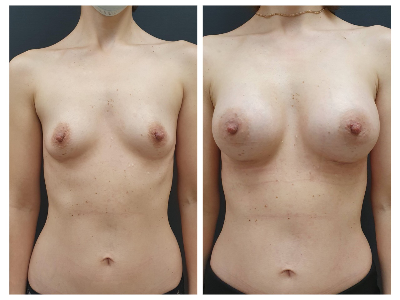 гормоны отвечающие за рост груди у женщин фото 69