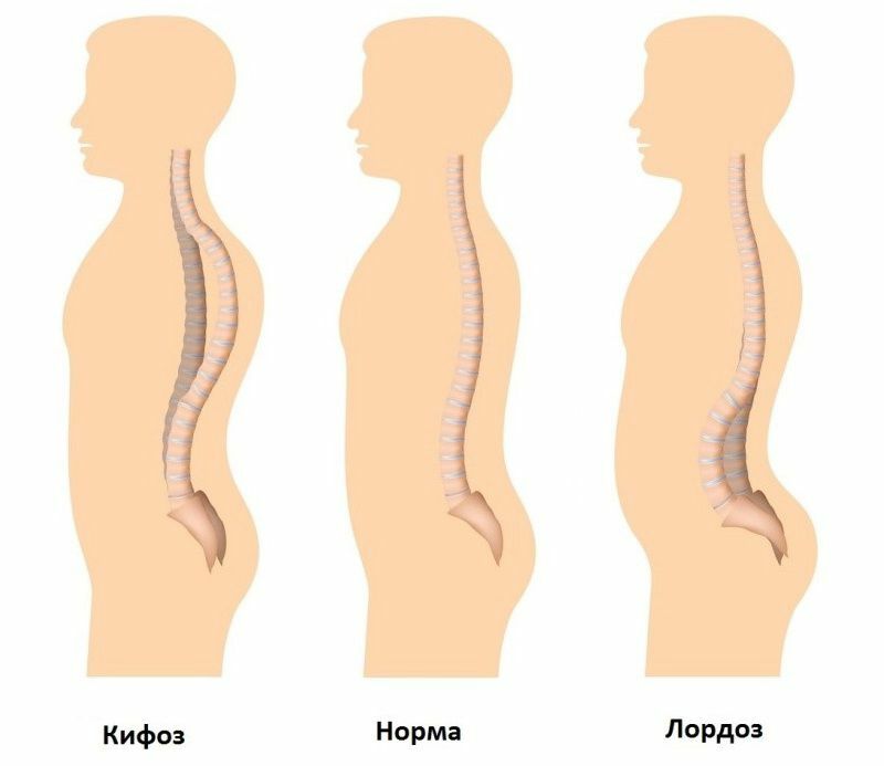 Лордоз позвоночника