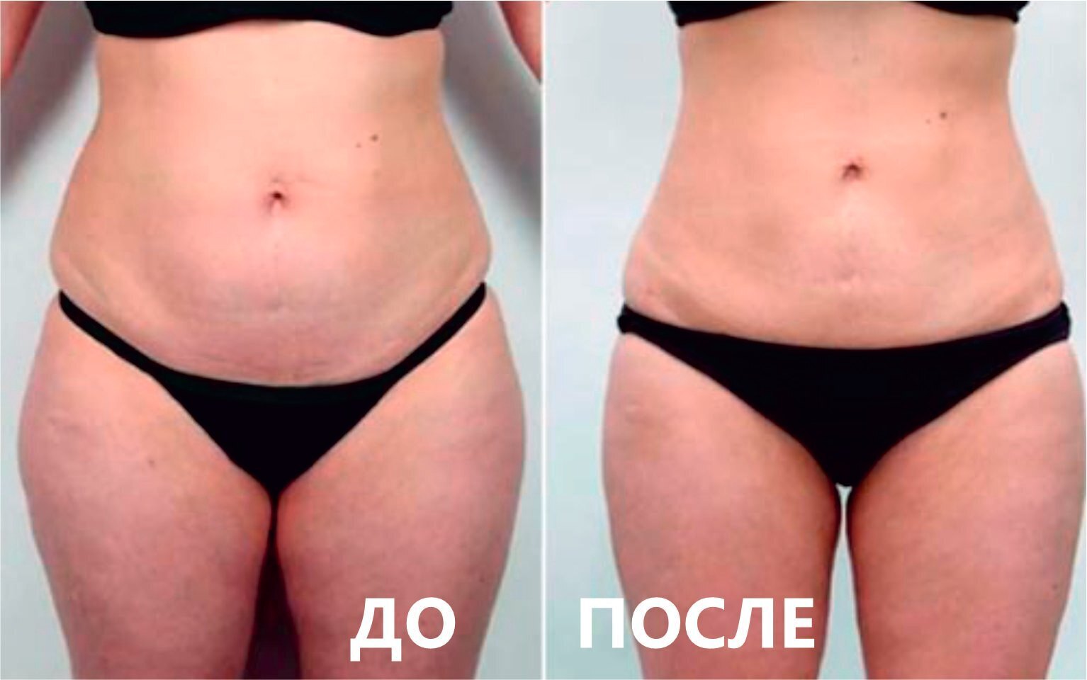 Криолиполиз до и после