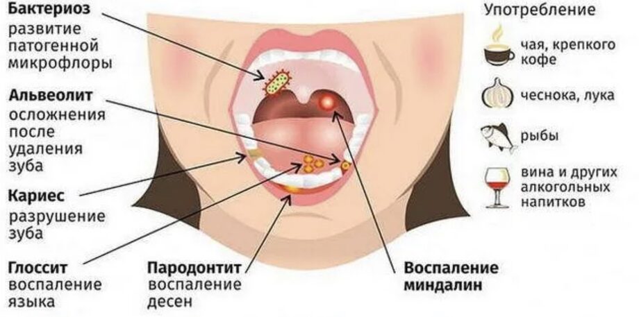 Может Ли Болеть Горло После Орального Секса Может Ли Болеть Горло После Орального Секса