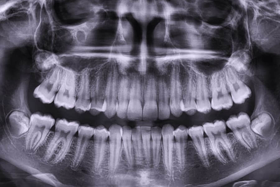 Панорамный снимок зубов Томск Урманская Импланты Имплантиум Томск Восточная