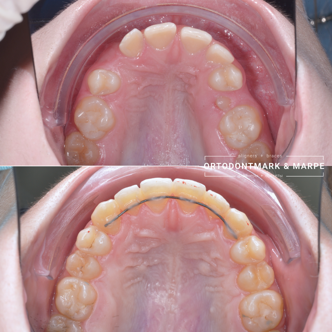 MARPE case result 12