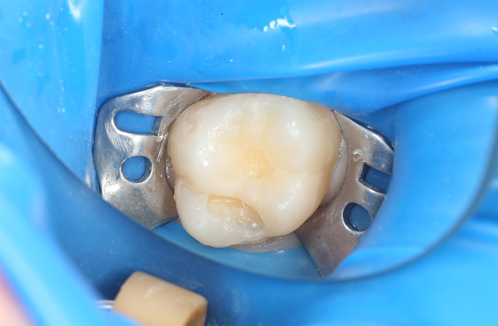 Восстановление жевательной поверхности постоянного зуба после кариозного разрушения у подростка