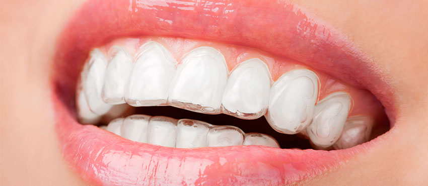 Почему болят зубы после установки брекетов?