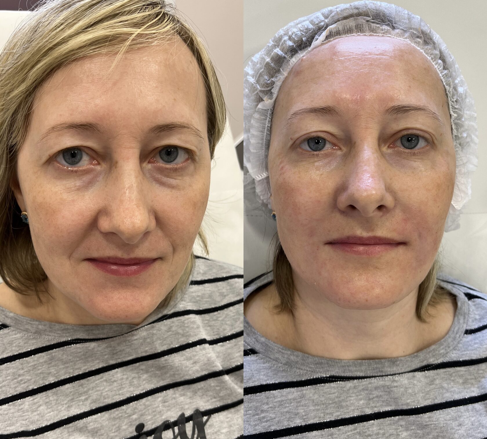 Коллагенотерапия лица до и после фото