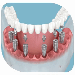 Имплантация все на 4, 6 имплантах. Протезирование зубов в Сургуте
