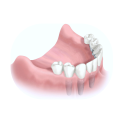 имплантация зубов, имплантация зубов Голицыно, стоматология в Голицыно, имплантация зубов цена, имплантация зубов под ключ, имплантация зубов под ключ цена, имплантация зубов МСК, имплантация Москва, зубной имплант Голицыно, установка импланта, зубное протезирование.