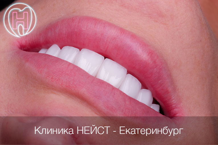 Красивые керамические виниры в Екатеринбурге цвет Блич 2 (Bleach 2)