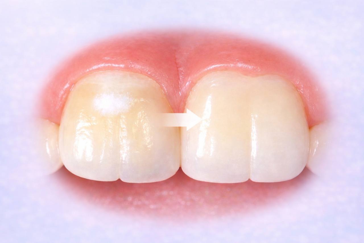 Лечение белых пятен — без сверления