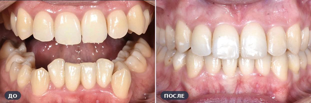 Ортодонтическое лечение: Скученность и открытый прикус — до и после