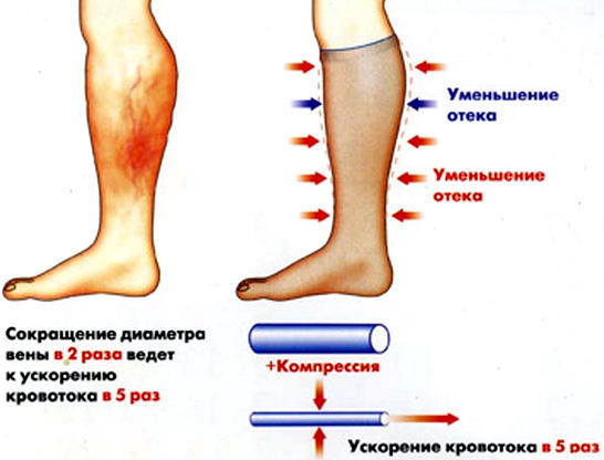 Лимфостаз – причина тяжести в ногах. Лечение лимфостаза - заболевания лимфатической системы.