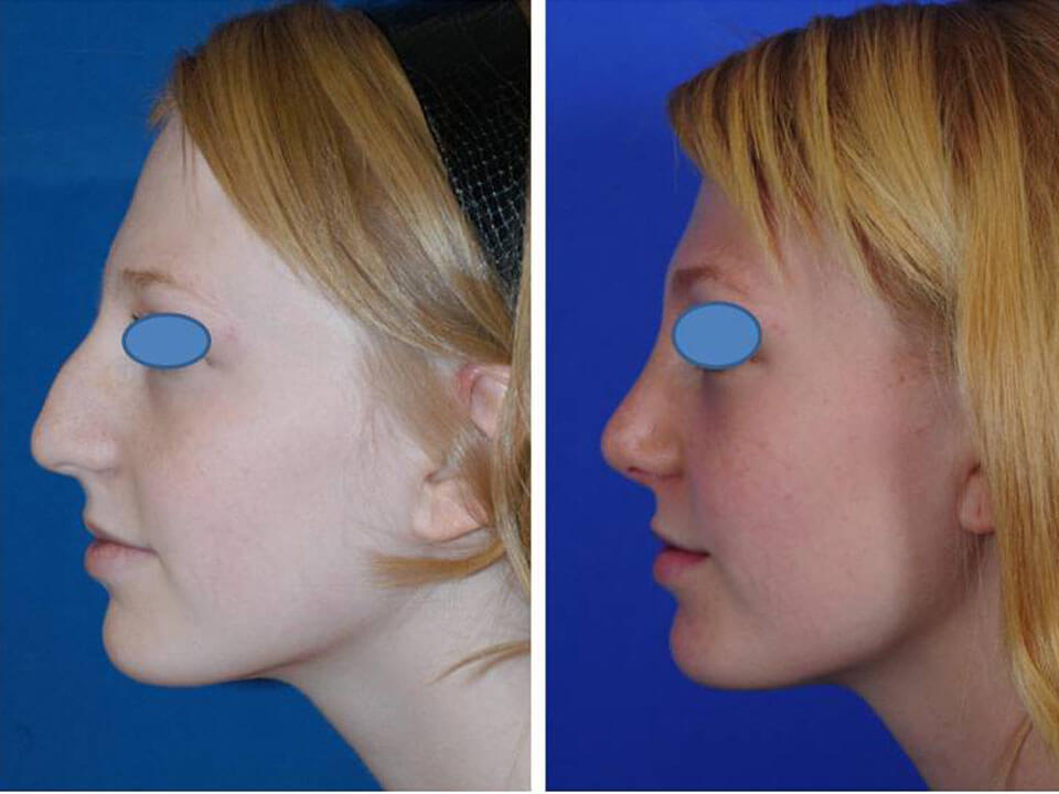 Пластическая хирургия фото нос