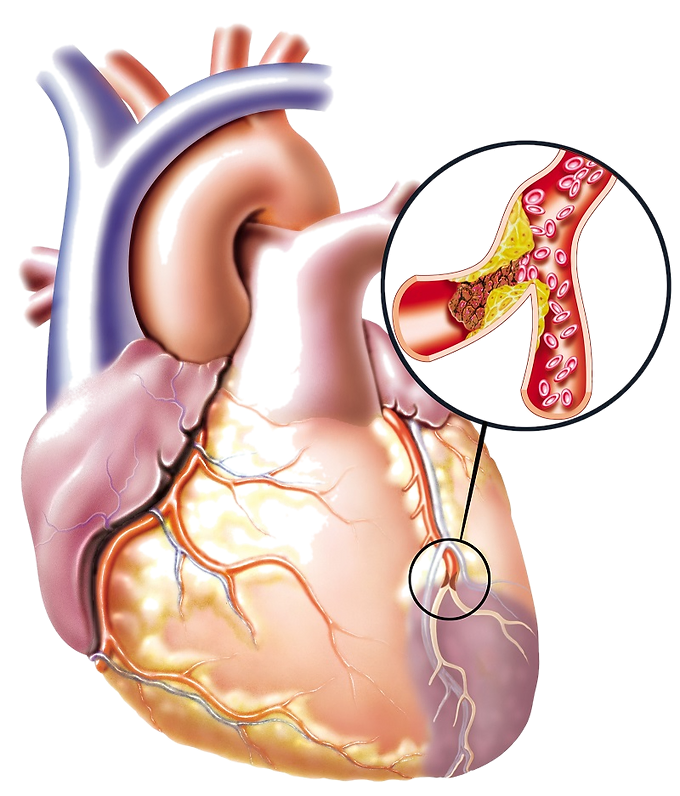 кардиолог липидолог что лечит 