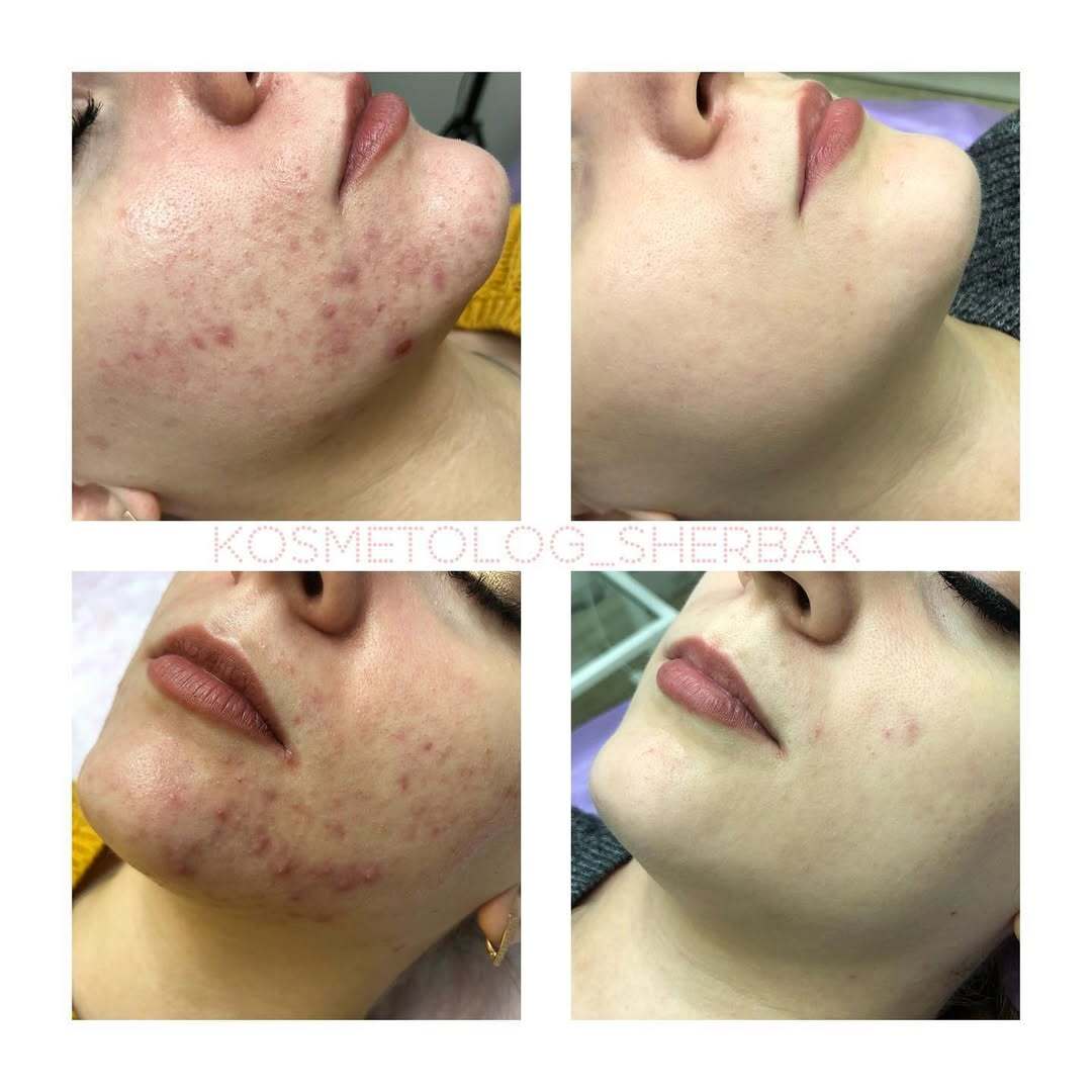 Лечение акне у женщины в клинике PradusCOSMO, СПб. До и после процедуры