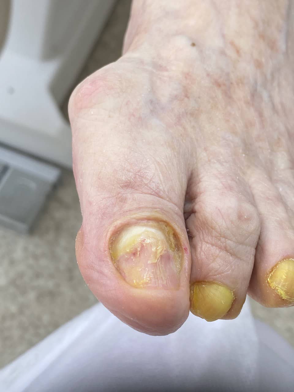 зачистка онихолизиса