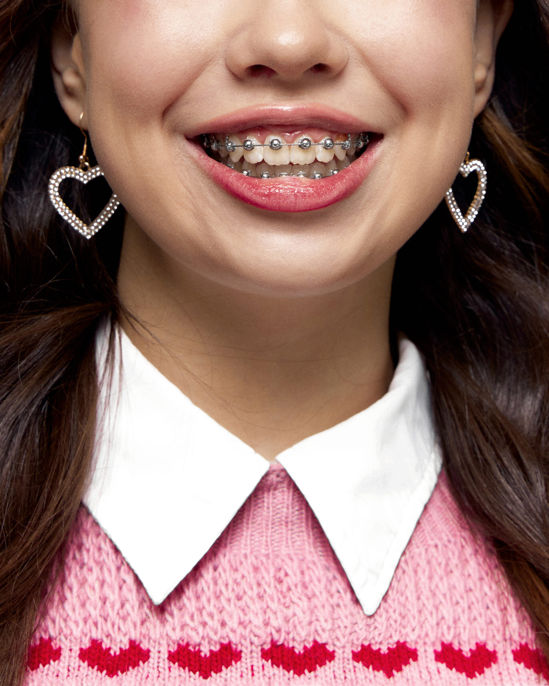 брекеты в Чебоксарах