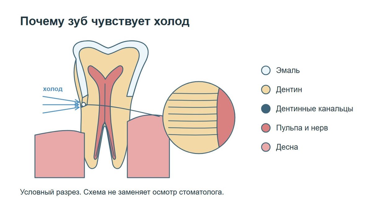 Схема эмали и дентина при чувствительности зуба