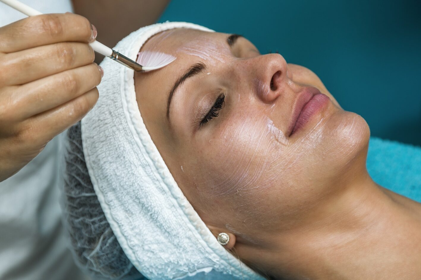 Химический пилинг